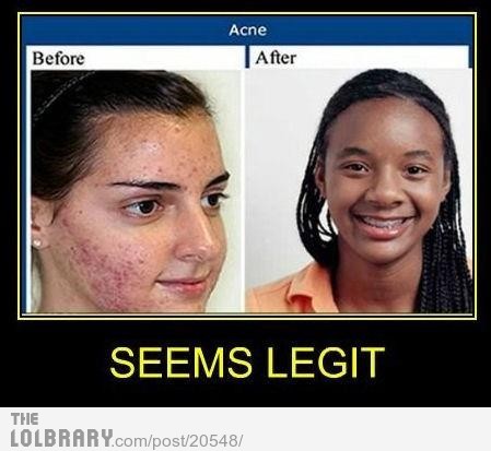 Picture of Acne - WebMD